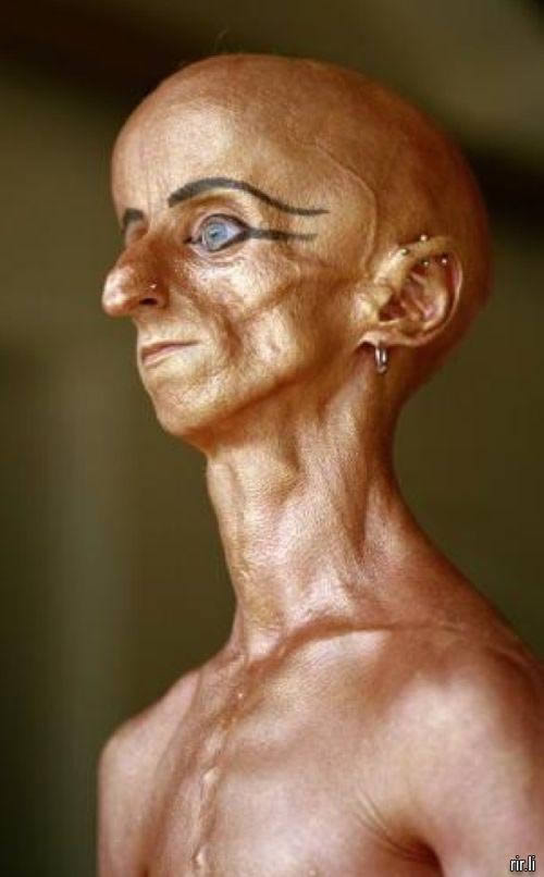 Leon Botha progeria (5)