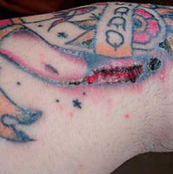 Infecciones de tatuajes y perforaciones (10)