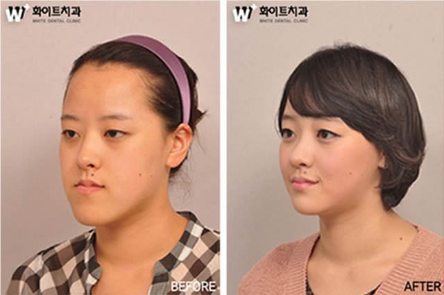 Cirugía plástica en Corea (14)