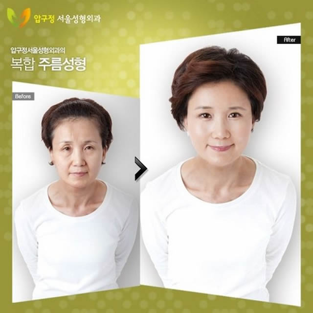 Cirugía plástica en Corea (12)
