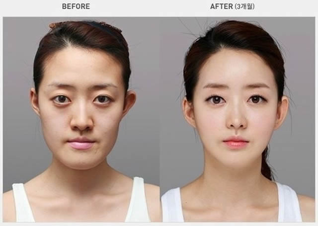 Cirugía plástica en Corea (11)