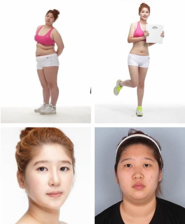 Cirugía plástica en Corea (28)