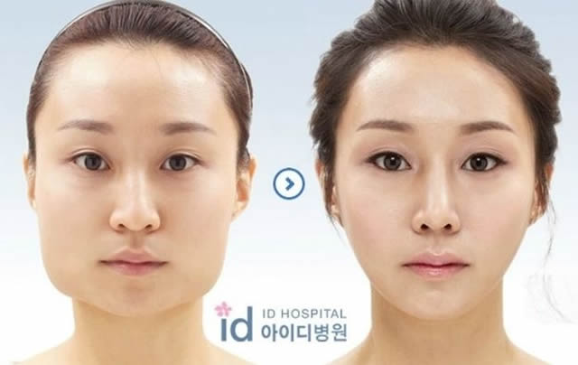 Cirugía plástica en Corea (23)