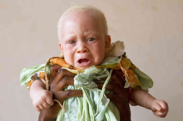 Persecución Caza Albinos Tanzania (14)