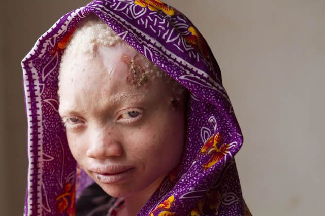 Persecución Caza Albinos Tanzania (12)