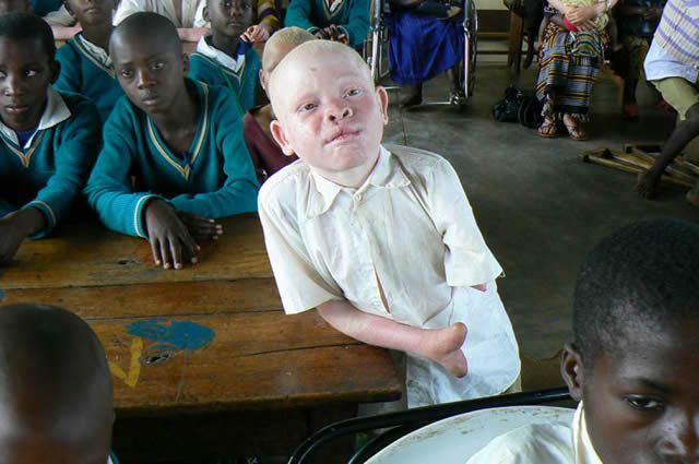 Persecución Caza Albinos Tanzania (6)
