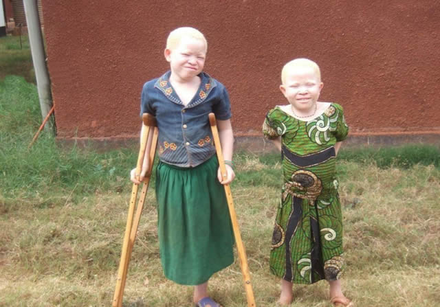 Persecución Caza Albinos Tanzania (5)
