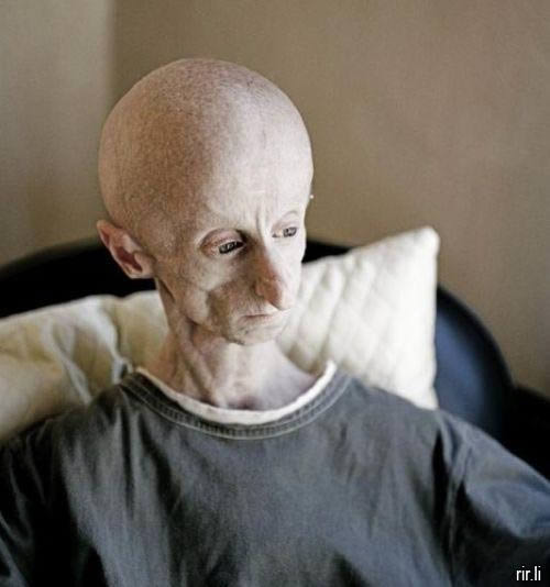 Leon Botha Progeria