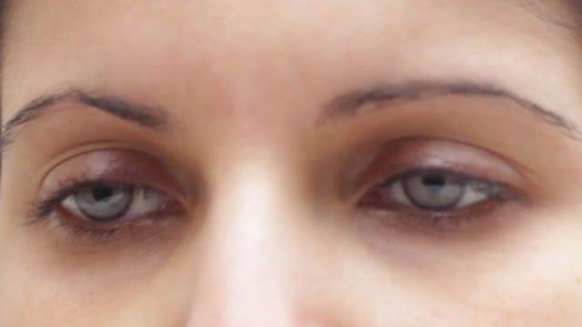 implante iris artificial, cambiar color de ojos (5)