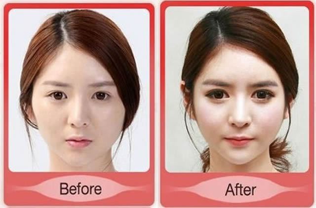 Cirugía Plástica en Corea Antes y Despues 2 (60)