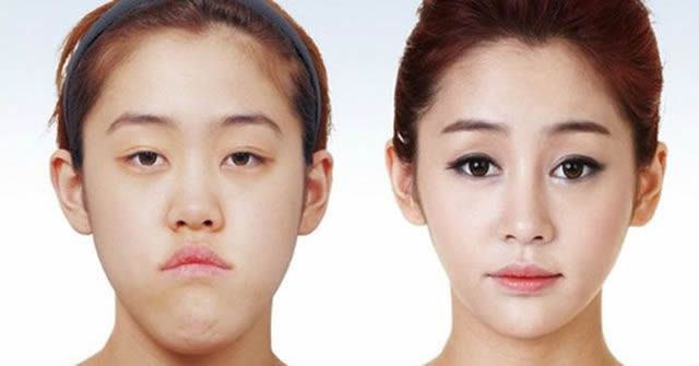 Cirugía Plástica en Corea Antes y Despues 2 (59)