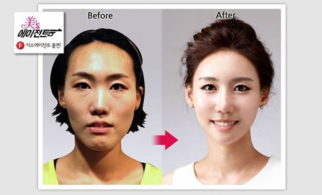 Cirugía Plástica en Corea Antes y Despues 2 (50)