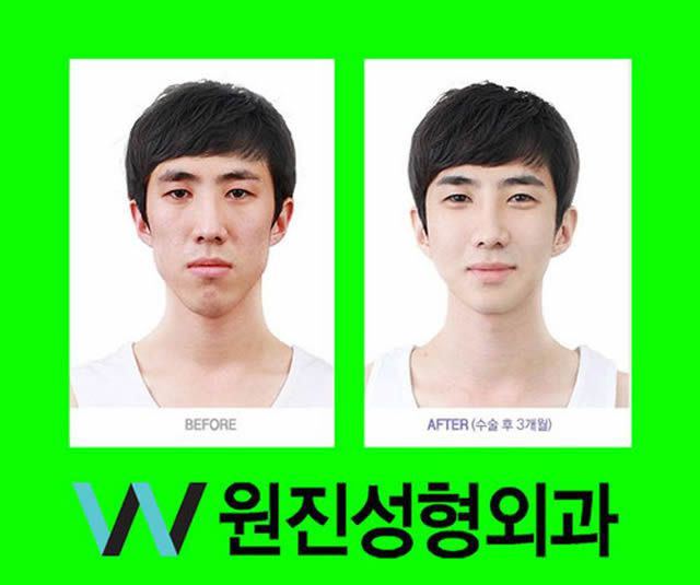 Cirugía Plástica en Corea Antes y Despues 2 (48)