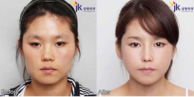 Cirugía Plástica en Corea Antes y Despues 2 (46)