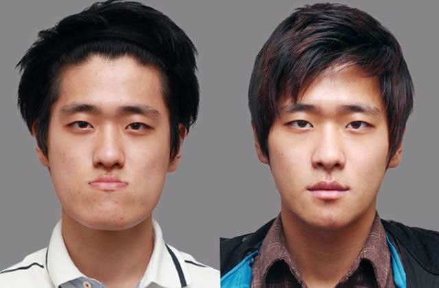 Cirugía Plástica en Corea Antes y Despues 2 (45)