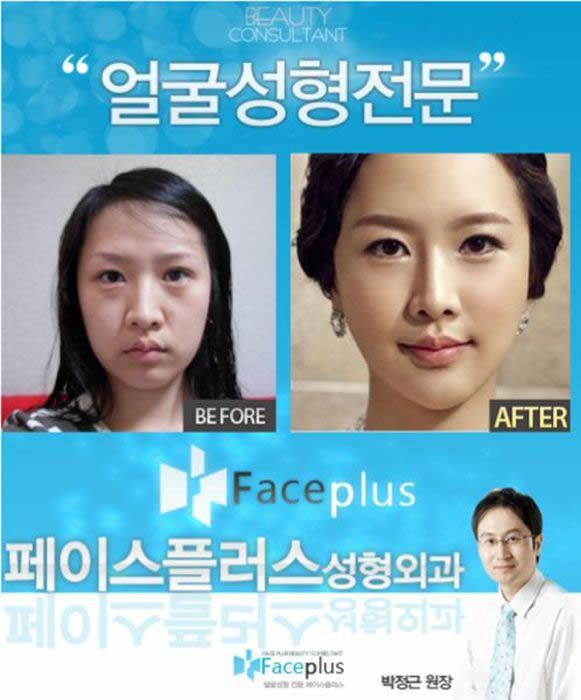 Cirugía Plástica en Corea Antes y Despues 2 (42)