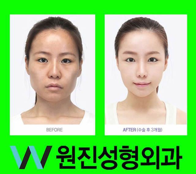 Cirugía Plástica en Corea Antes y Despues 2 (37)