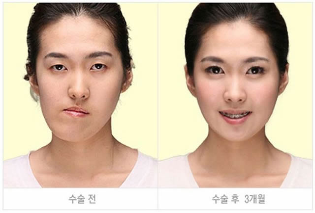 Cirugía Plástica en Corea Antes y Despues 2 (36)