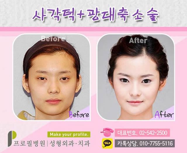 Cirugía Plástica en Corea Antes y Despues 2 (35)