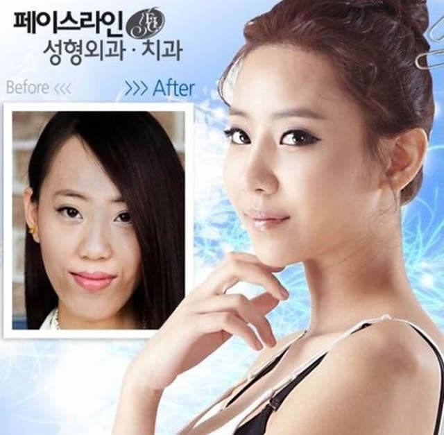 Cirugía Plástica en Corea Antes y Despues 2 (32)