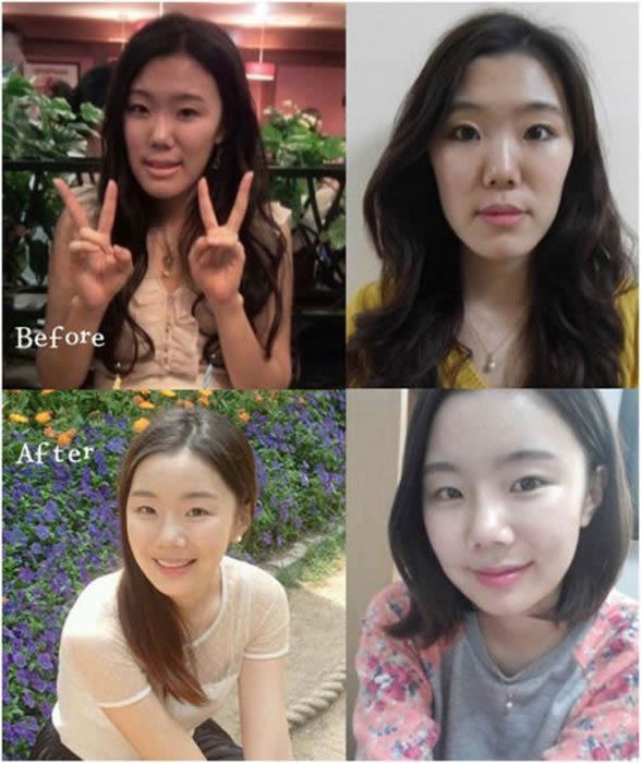Cirugía Plástica en Corea Antes y Despues 2 (30)