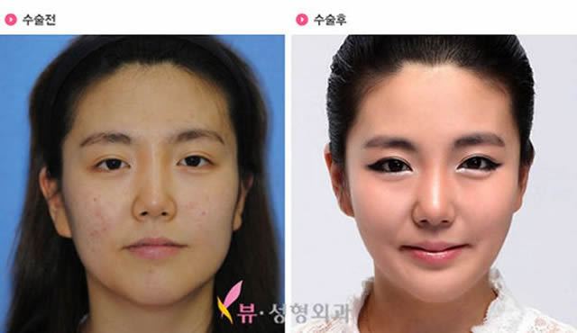 Cirugía Plástica en Corea Antes y Despues 2 (28)