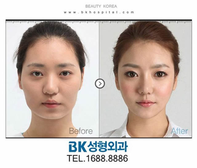 Cirugía Plástica en Corea Antes y Despues 2 (26)