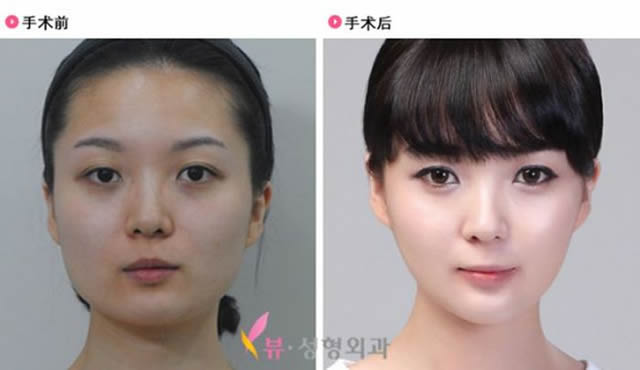 Cirugía Plástica en Corea Antes y Despues 2 (22)