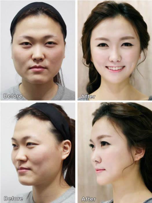 Cirugía Plástica en Corea Antes y Despues 2 (20)