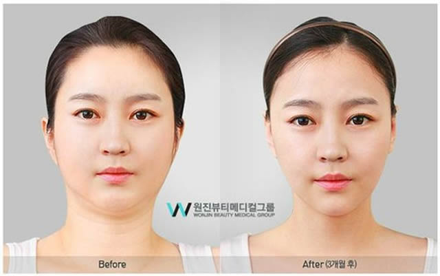 Cirugía Plástica en Corea Antes y Despues 2 (19)
