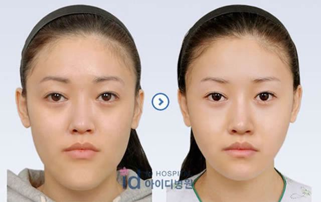 Cirugía Plástica en Corea Antes y Despues 2 (17)