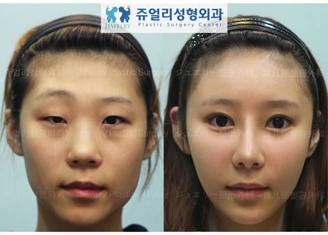 Cirugía Plástica en Corea Antes y Despues 2 (16)