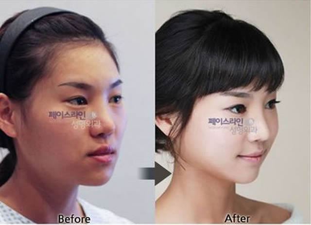 Cirugía Plástica en Corea Antes y Despues 2 (14)
