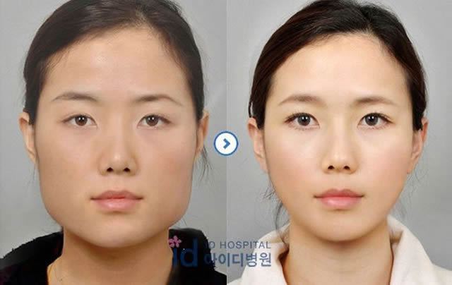 Cirugía Plástica en Corea Antes y Despues 2 (11)