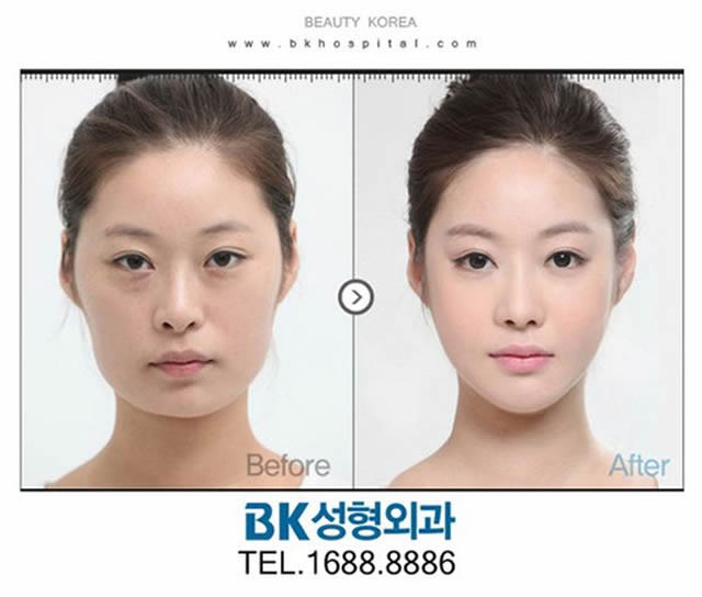 Cirugía Plástica en Corea Antes y Despues 2 (9)