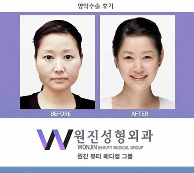 Cirugía Plástica en Corea Antes y Despues 2 (7)