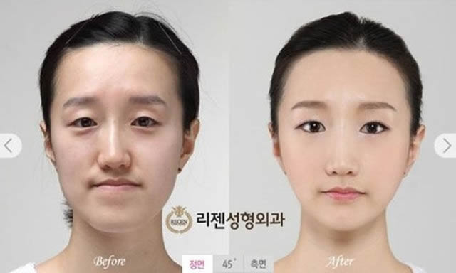 Cirugía Plástica en Corea Antes y Despues 2 (6)