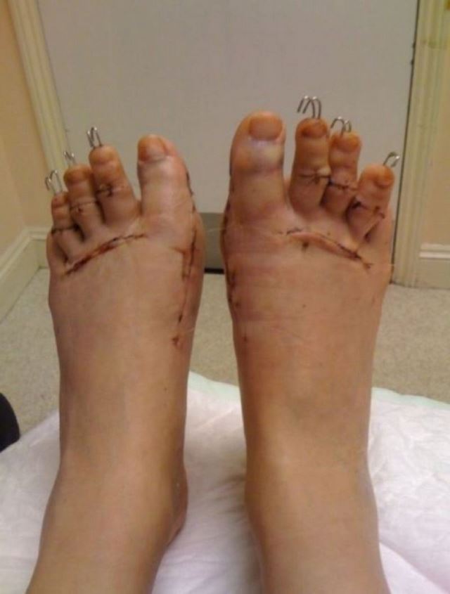 Cirugía Cenicienta pies (5)