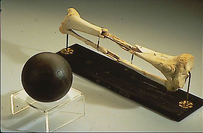 Hueso de la pierna apuntada de Sickles junto a una bala de cañón. El general donó su pierna al Museo Nacional de Salud y Medicina de Maryland, donde aún pueden apreciarse los huesos en exposición.