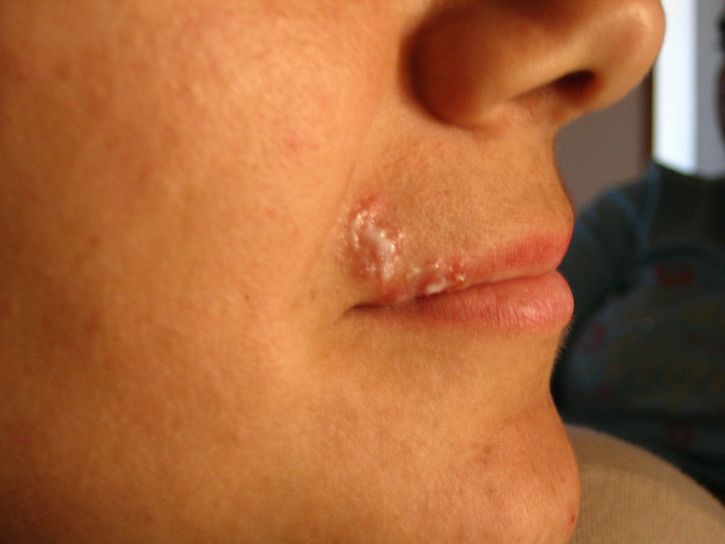 herpes simple boca