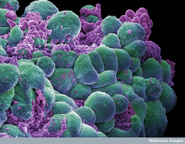celulas cancer de mama miscroscopio