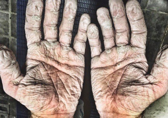 manos destruidas por la humedad