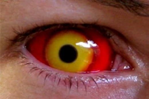 lentes de contacto infeccion ocular