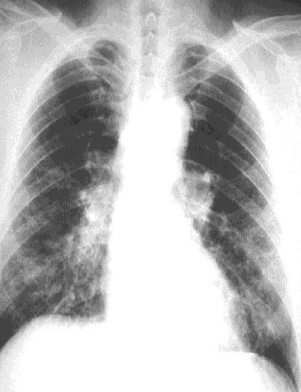 radiografia asbestosis