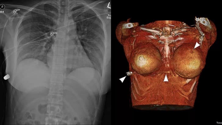 implante mamario desvia bala tomografia