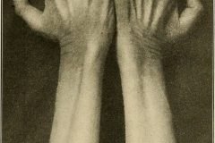 manos enfermedades nerviosas