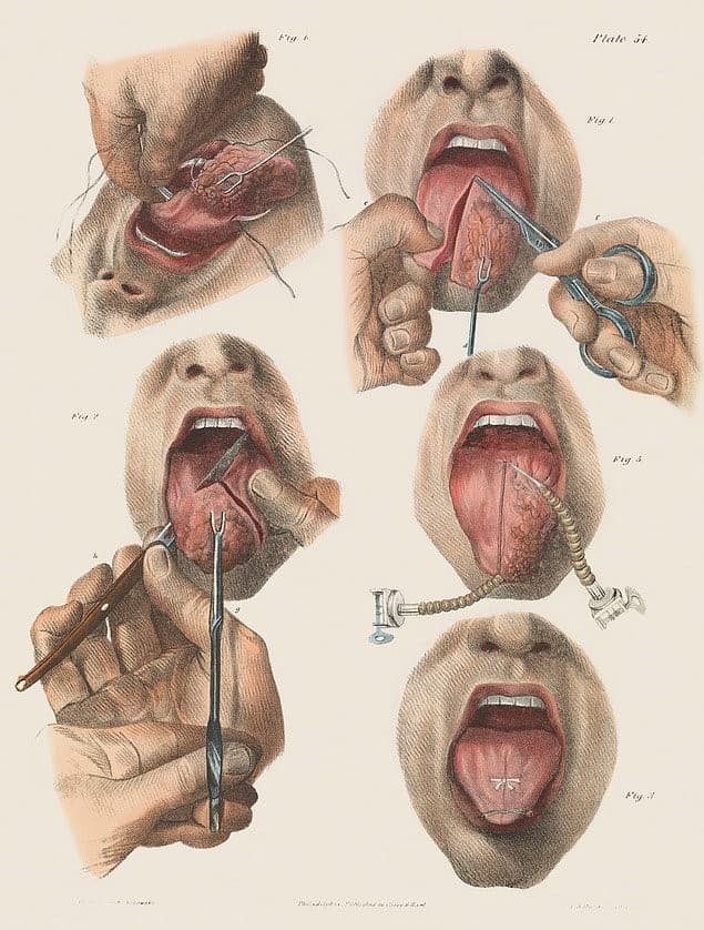 cirugia tumor lengua pasado