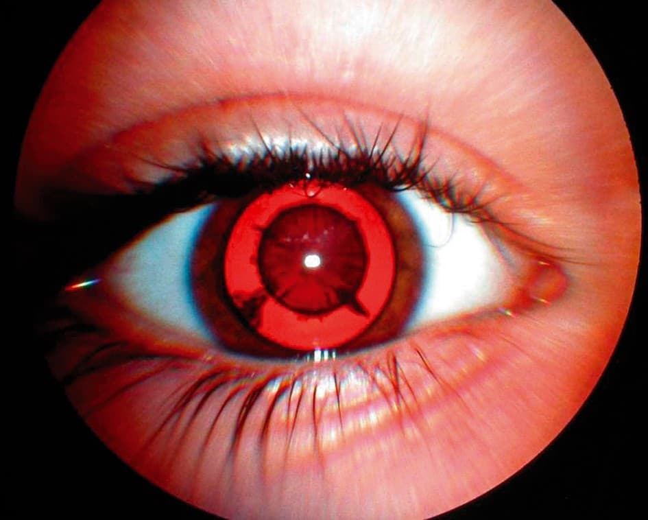ojo rojo con catarata