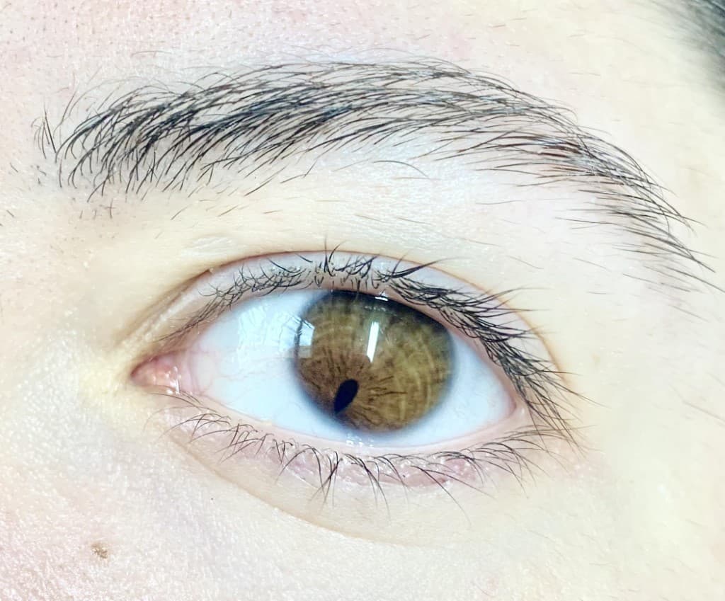 ojo con el iris abajo deoforme